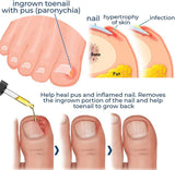 1+1 Gratis | HealNail™ Reparatur beschädigter Nägel in 4 Wochen