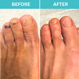 50% OFF TEMPORÄR | FungiZap™