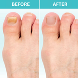 50% OFF TEMPORÄR | FungiZap™