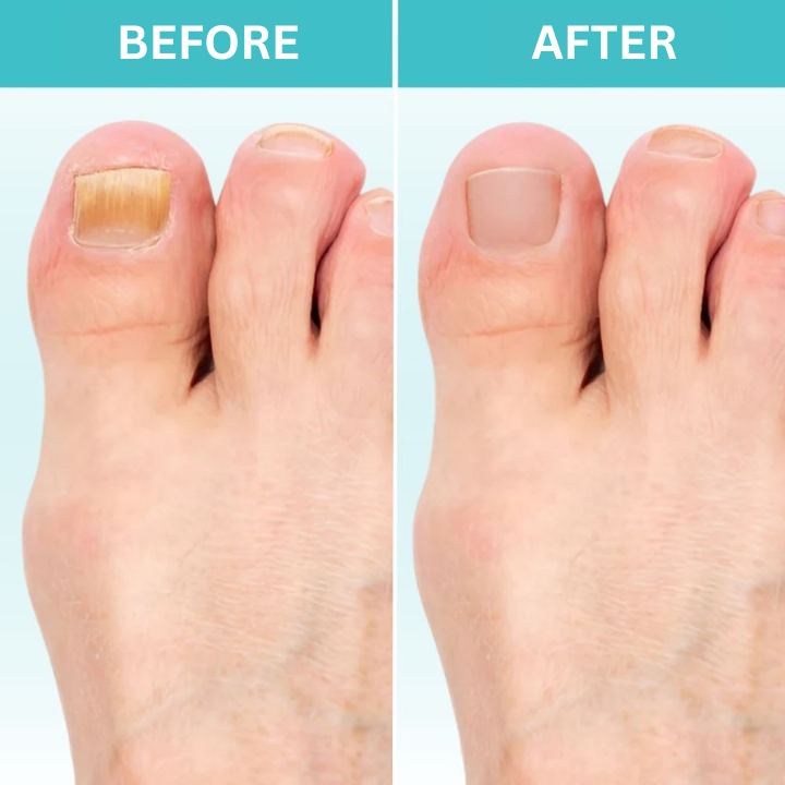 50% OFF TEMPORÄR | FungiZap™