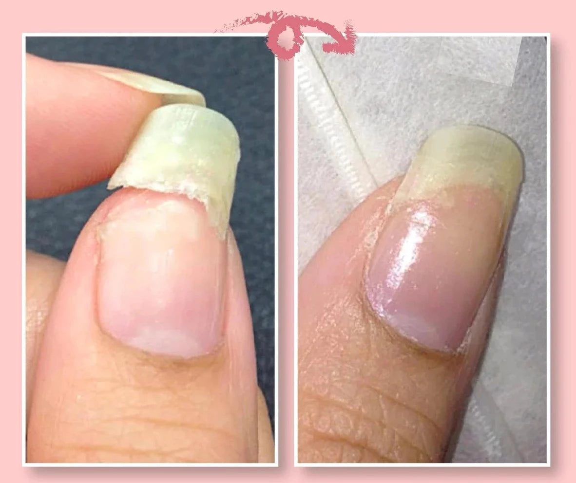 FavNail™ - Repair your broken nails
