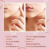 FlawlessFade™ | Verabschieden Sie sich von Hautunreinheiten