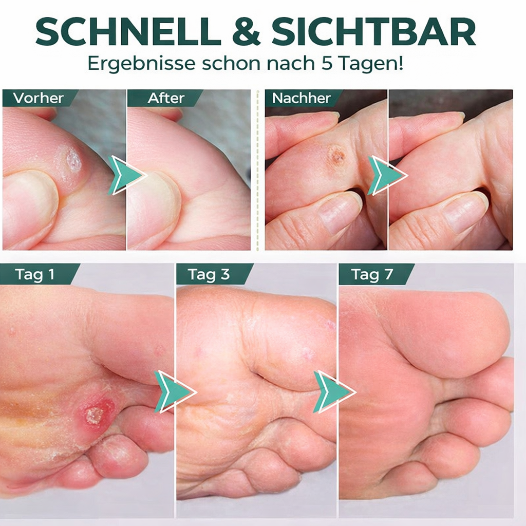 Hühneraugenentferner Gel | Extra Stark & Schmerzfrei | FootPro