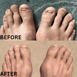 NailRenew™ | Nagelpilz bekämpfen und beseitigen!