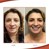 Passgenau & Biokompatibel | Schmerzfreier Sitz | Natürliches Lächeln | ProthesenKumpel Silikon-Set