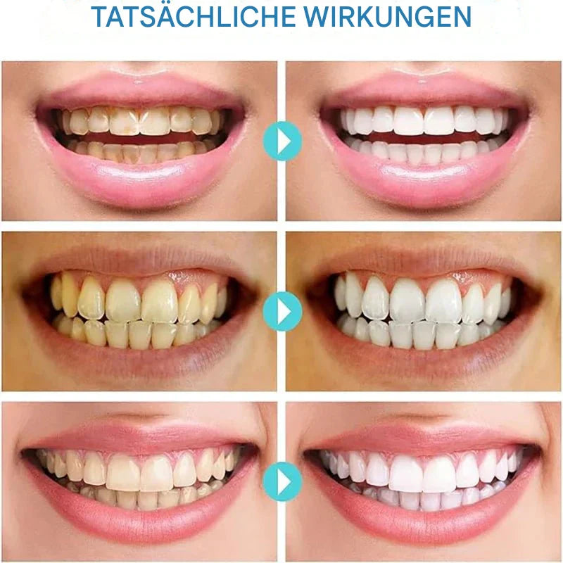 PureTeeth™ - Sofortige Aufhellung