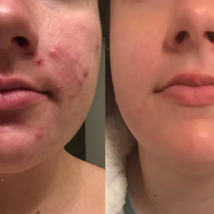 SkinMend™ | Silikon-Narbenblätter