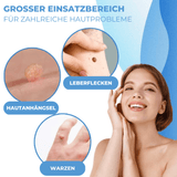 Warzen & Muttermale Entferner Set | Schmerzfrei | Schnelle Ergebnisse | Für alle Hauttypen