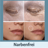 Hautanhängsel Entferner Pflaster | Schmerzfrei & Natürlich | Diskret & Effektiv | PatchEase