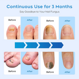 NailRenew™ | Nagelpilz bekämpfen und beseitigen!