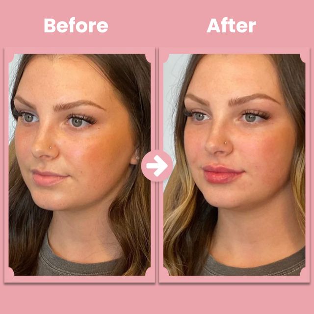 VoluFleur™ Lippenroller – Stimulieren Sie die Kollagenproduktion für weichere, vollere Lippen in wenigen Tagen