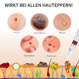 WartOff Hautflecken Entferner | Schmerzfrei | Natürliche Formel | 1+1 Gratis
