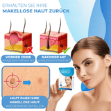 Warzen & Muttermale Entferner Set | Schmerzfrei | Schnelle Ergebnisse | Für alle Hauttypen